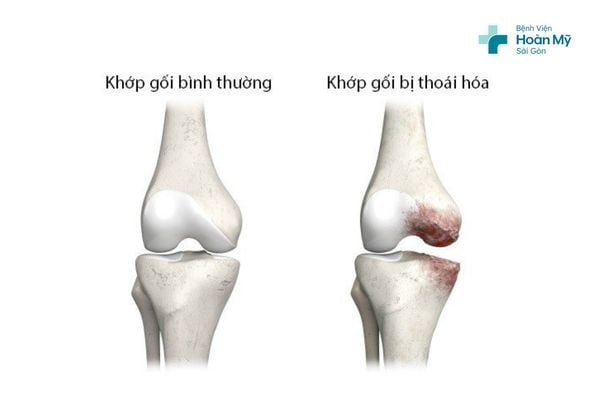 Bệnh viện Hoàn Mỹ Sài Gòn áp dụng phương pháp thay khớp gối nhân tạo cho người thoái hóa khớp nặng