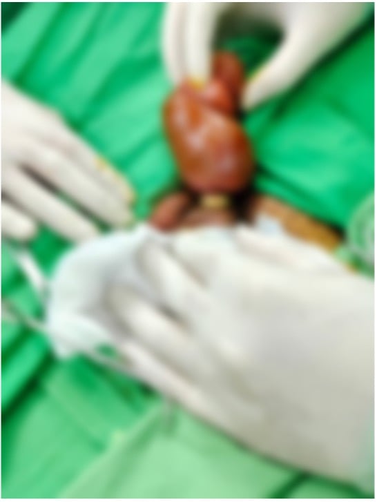 CẤP CỨU NAM THANH NIÊN ĐEO NHẪN VÀO DƯƠNG VẬT CÓ NGUY CƠ HOẠI TỬ