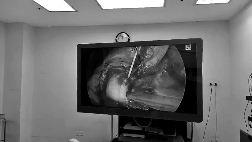 BỊ ĐAU TỨC NGỰC NHIỀU GIỜ, CỤ BÀ 78 TUỔI ĐƯỢC PHÁT HIỆN THỦNG DẠ DÀY DO XƯƠNG CÁ ĐÂM