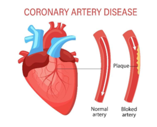 TẦM SOÁT BỆNH MẠCH VÀNH