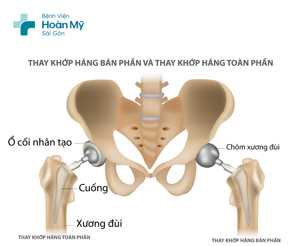 Những điều cần biết về phẫu thuật thay khớp háng nhân tạo 