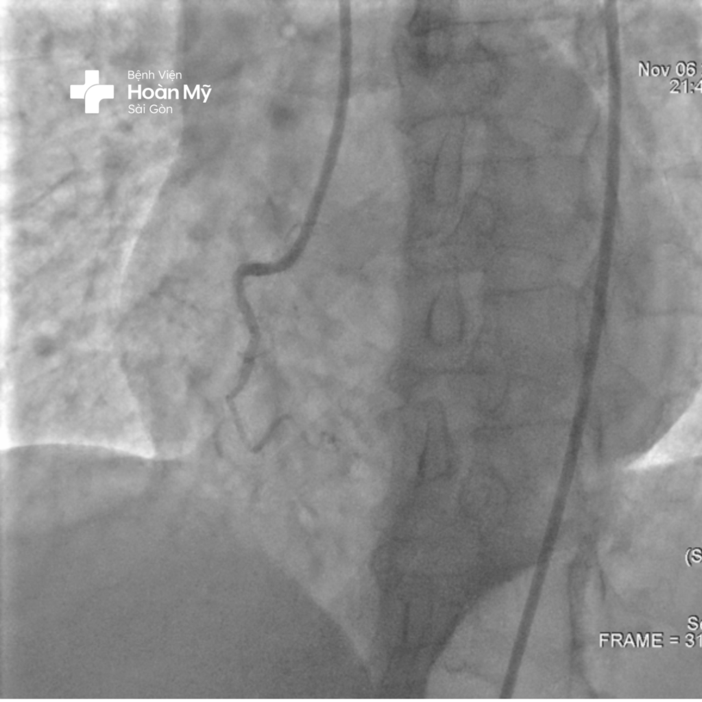 Kịp thời cứu sống người bệnh nhồi máu cơ tim cấp