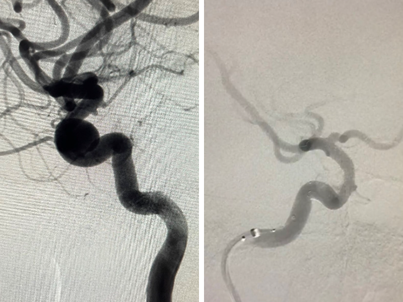 Thường xuyên đau đầu, người phụ nữ suýt mất mạng vì túi phình mạch não khổng lổ | Bệnh viện Hoàn Mỹ Sài Gòn