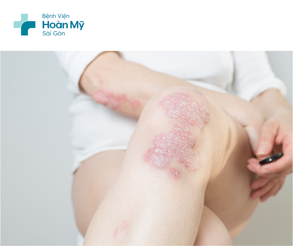 Cách điều trị bệnh vảy nến hiệu quả