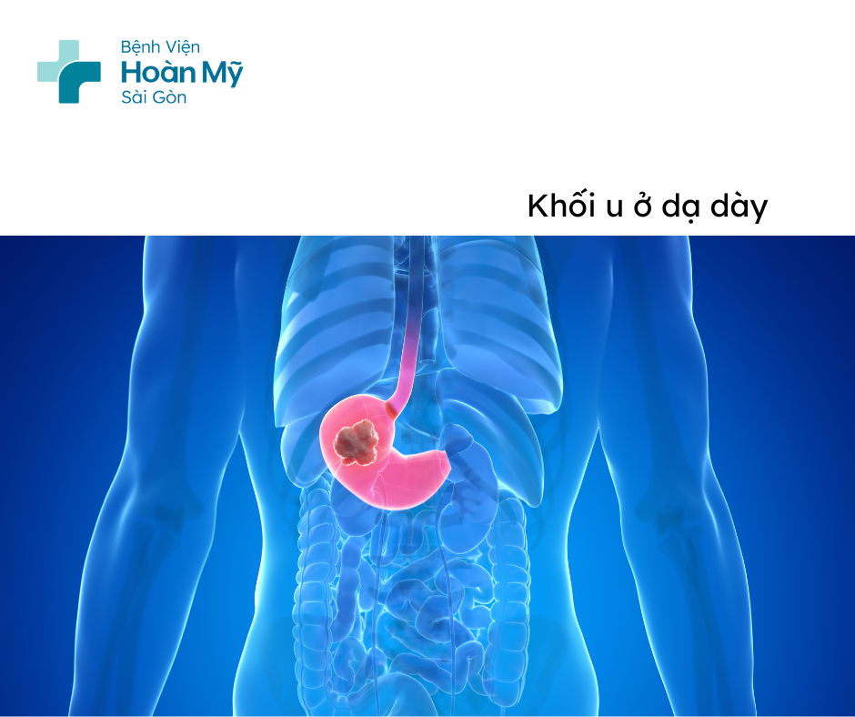 Ung thư dạ dày có nguy hiểm không? Chẩn đoán và điều trị ung thư dạ dày