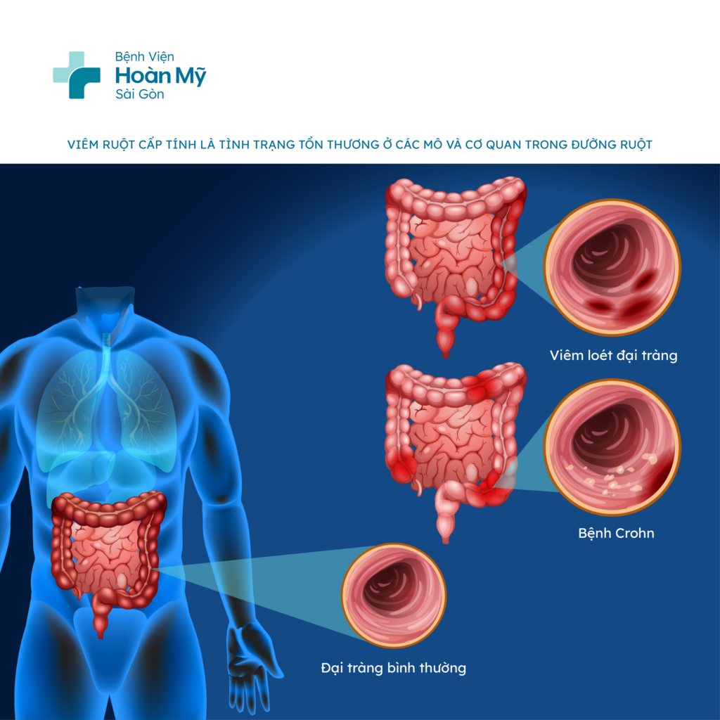 Cách chữa viêm ruột cấp tính hiệu quả