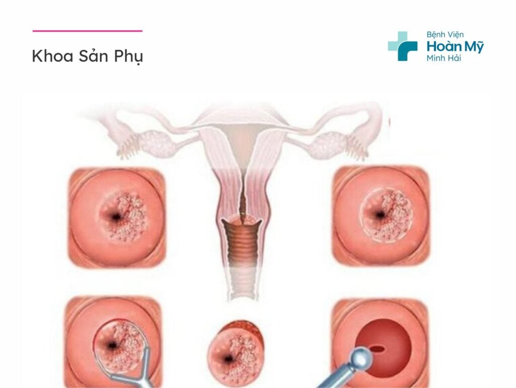 Áp lạnh cổ tử cung là gì?
