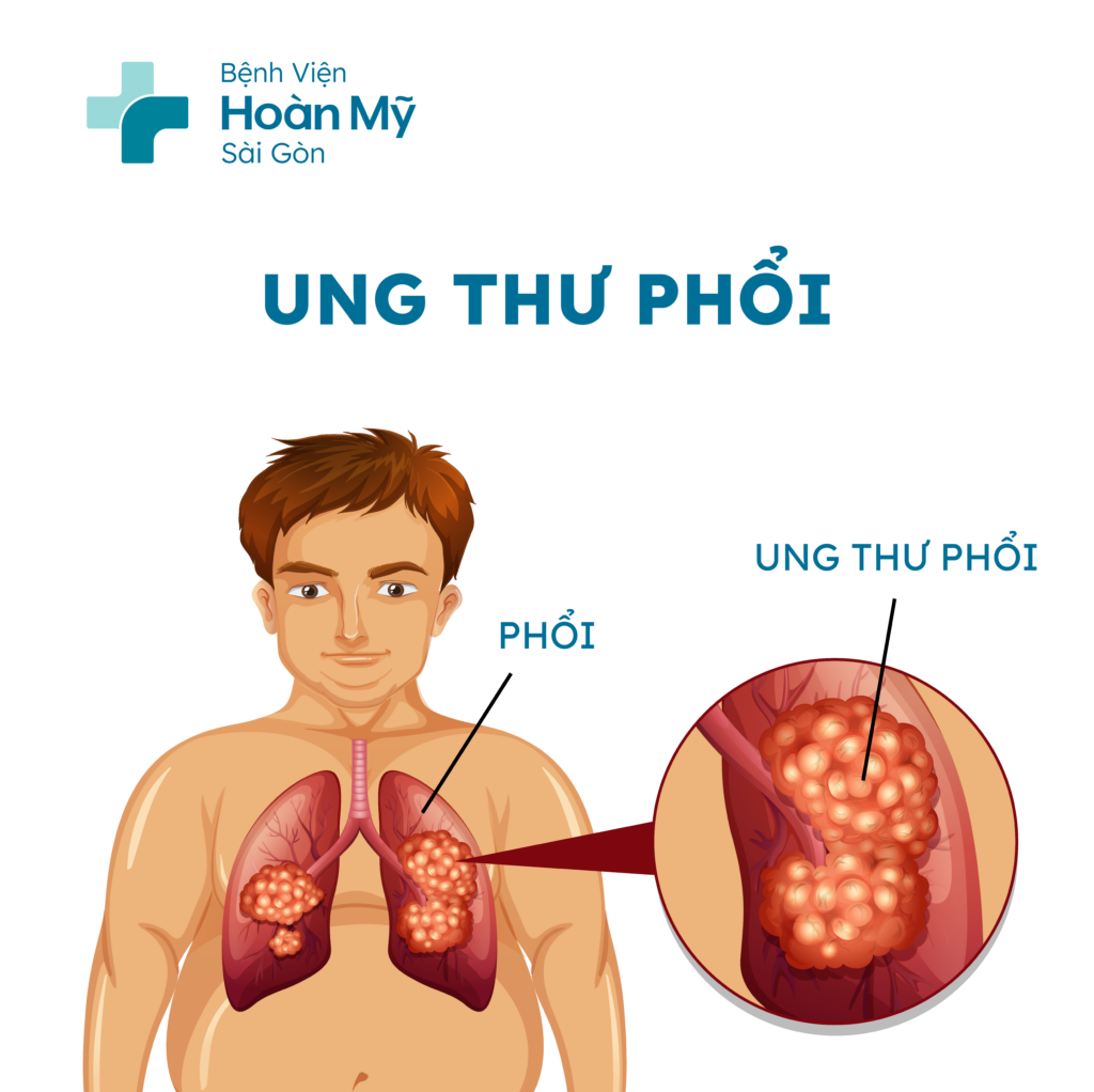 Phương pháp đốt u phổi mang lại nhiều cơ hội sống cho người ung thư phổi