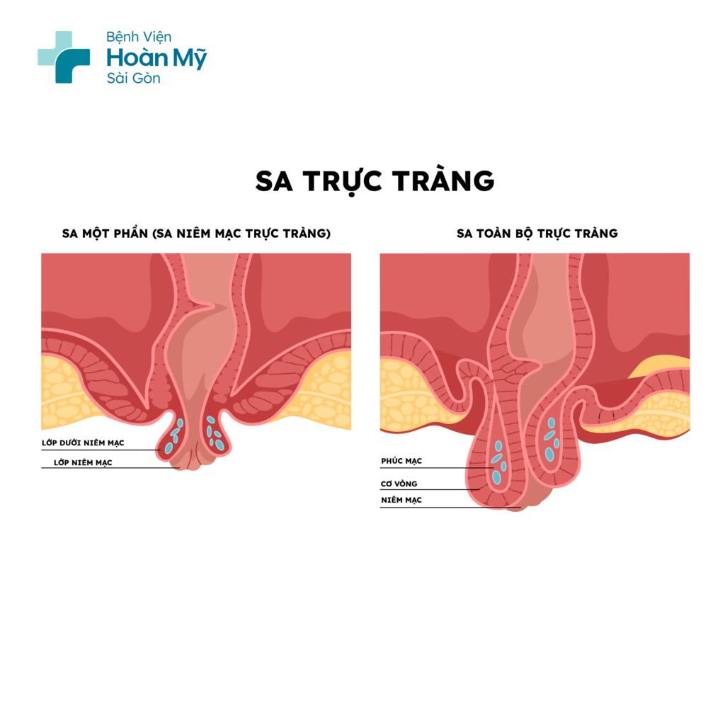 Các phương pháp điều trị bệnh trĩ nhanh chóng và hiệu quả