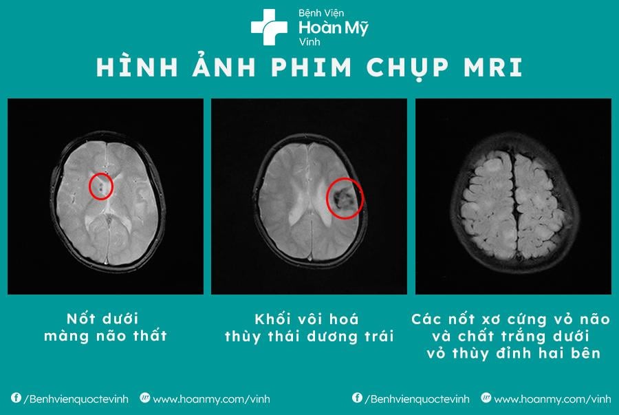 Bệnh lý xơ cứng củ