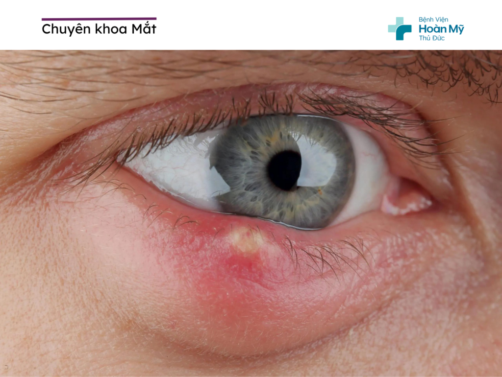 Điều trị bệnh chắp mắt và lẹo mắt