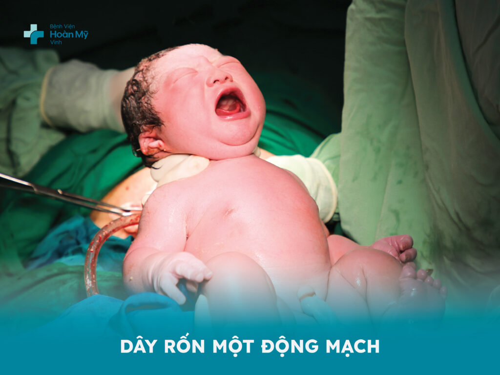 Dây rốn một động mạch