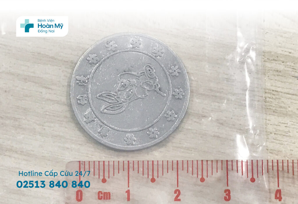 Đồng xu mắc kẹt trong thực quản bé 5 tuổi: Hiểm họa từ vật nhỏ