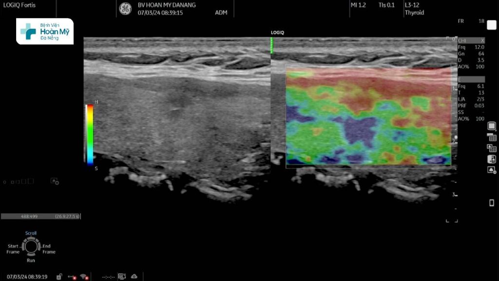 Siêu âm chẩn đoán u ác tính tuyến giáp trên máy siêu âm cao cấp LOGIQ Fortis thế hệ mới
