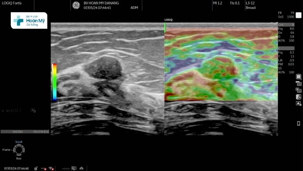 Siêu âm chẩn đoán tổn thương u vú trên máy siêu âm cao cấp LOGIQ Fortis thế hệ mới