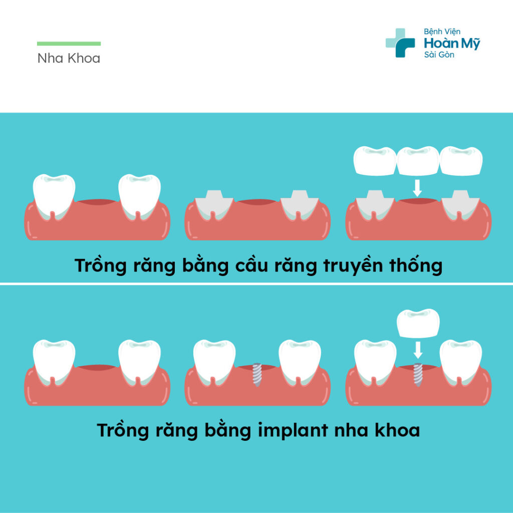 Hậu quả mất răng và phương pháp phục hồi hiệu quả