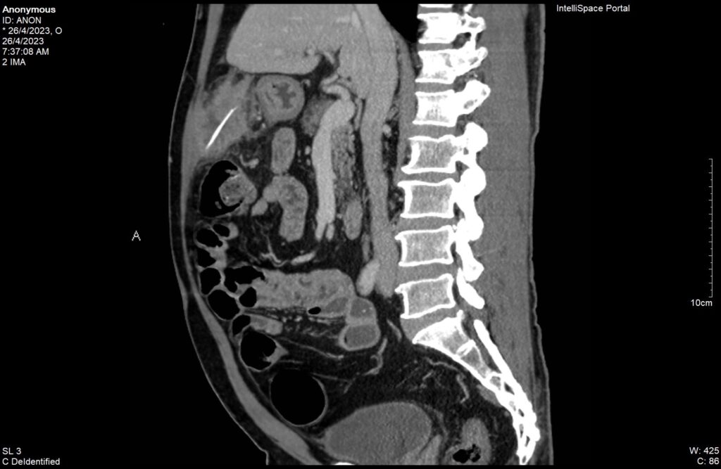 Khẩn cấp nội soi gắp xương cá 4 cm đâm xuyên hang vị dạ dày | Bệnh viện Hoàn Mỹ Sài Gòn