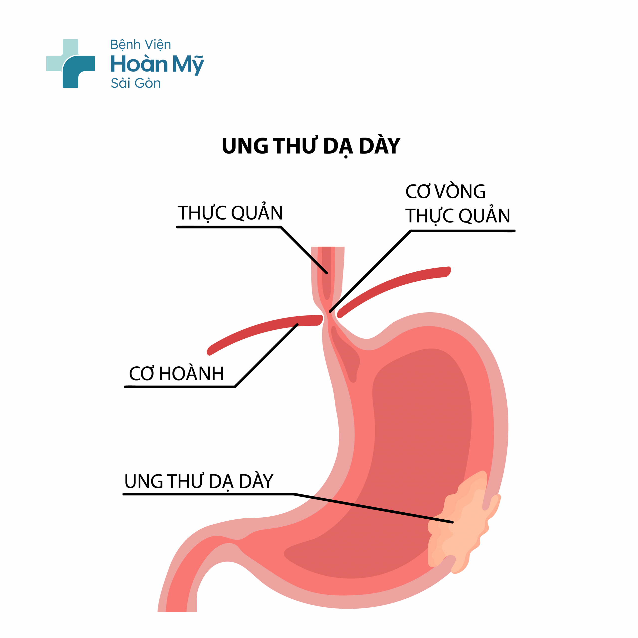 Điều trị ung thư dạ dày ở đâu tốt?