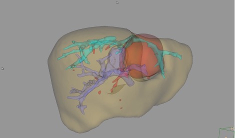 U máu gan có nguy hiểm không? Nguyên nhân, triệu chứng và cách phòng ngừa