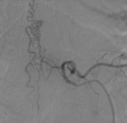 Yếu liệt hai chân kéo dài, người đàn ông khỏe mạnh phát hiện mắc bệnh lý hiếm gặp  
