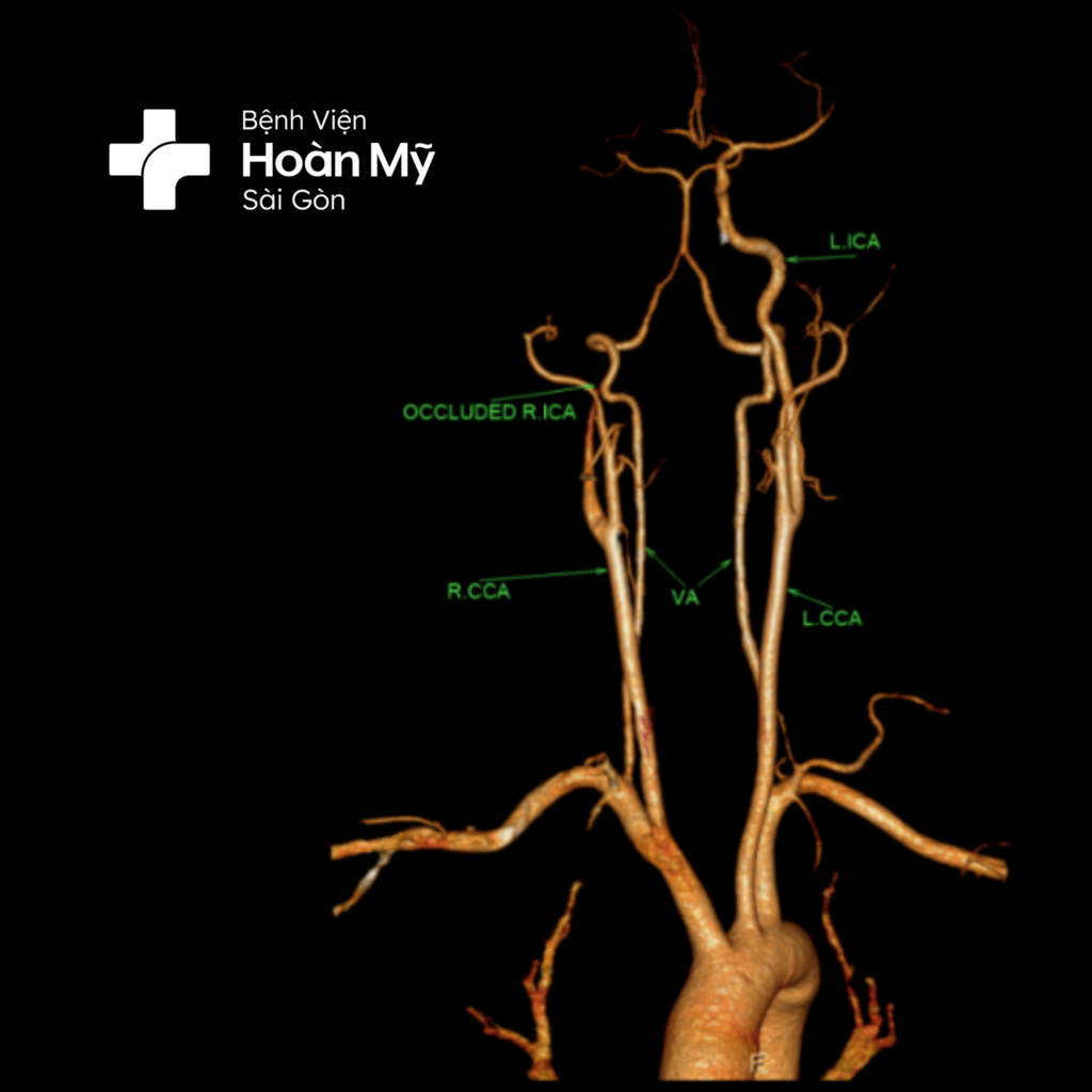 Ngủ dậy bỗng dưng liệt nửa người – Người đàn ông thoát chết nhờ cấp cứu kịp thời trong thời gian vàng