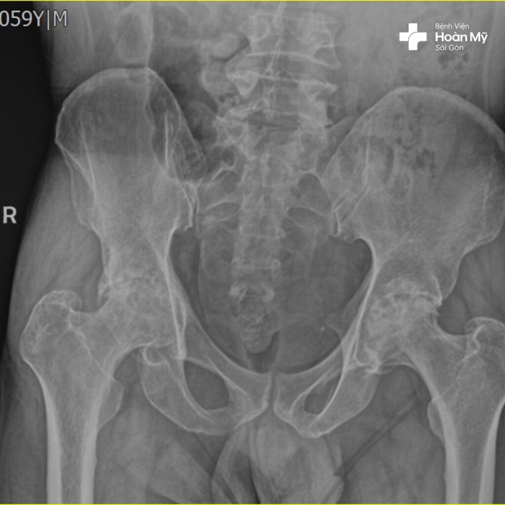 Phục hồi chức năng đi lại sau 3 ngày phẫu thuật nhờ quyết định thay khớp háng cùng lúc