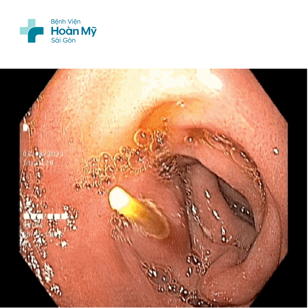 Mối nguy hiểm dị vật từ cây tăm nhỏ