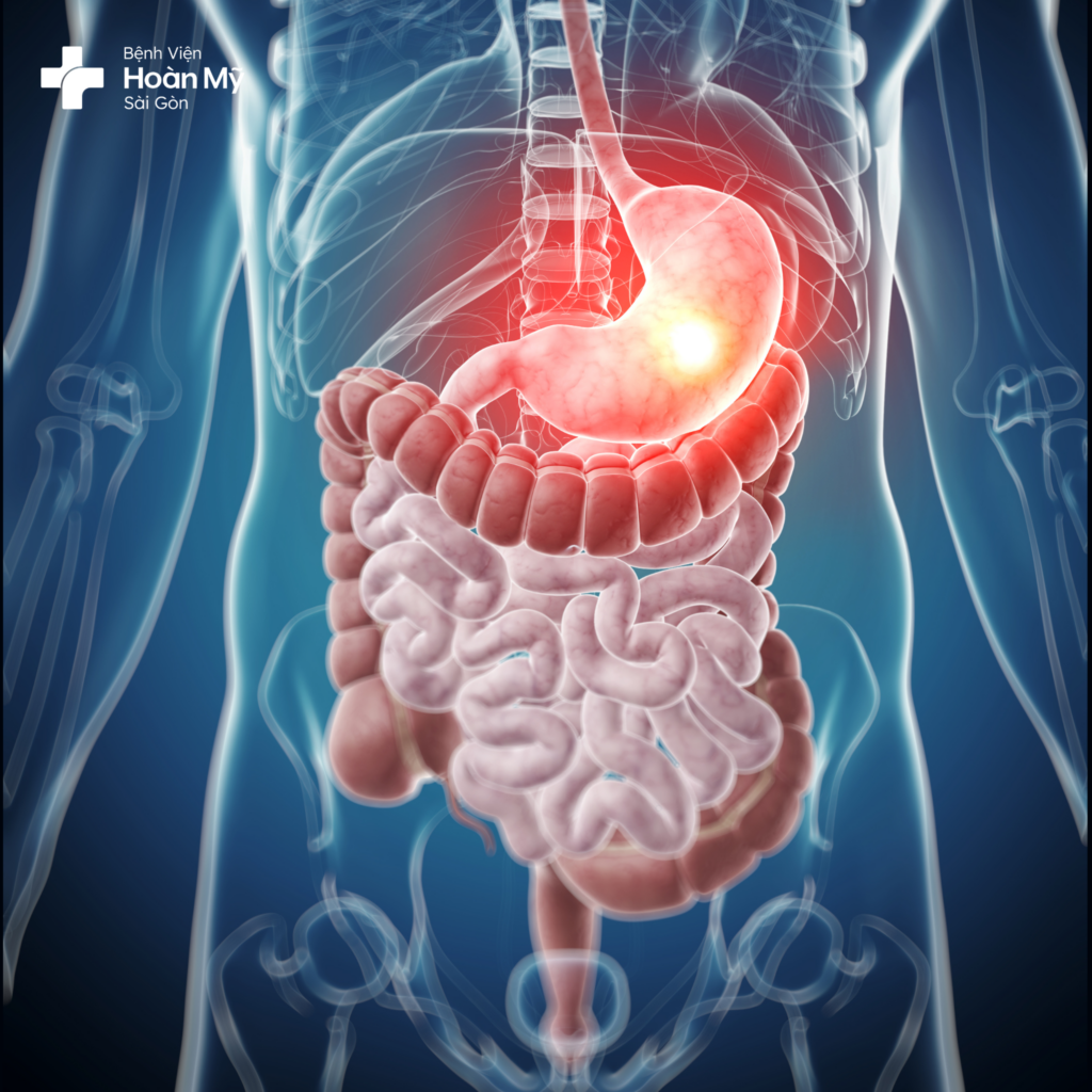 THỦNG DẠ DÀY DO VÔ TÌNH NUỐT PHẢI TĂM XỈA RĂNG 