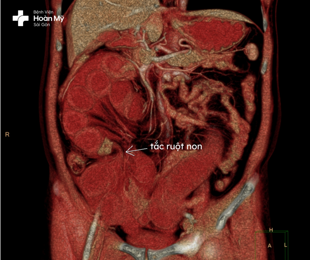 Cứu sống trường hợp tắc ruột non do xoắn ruột