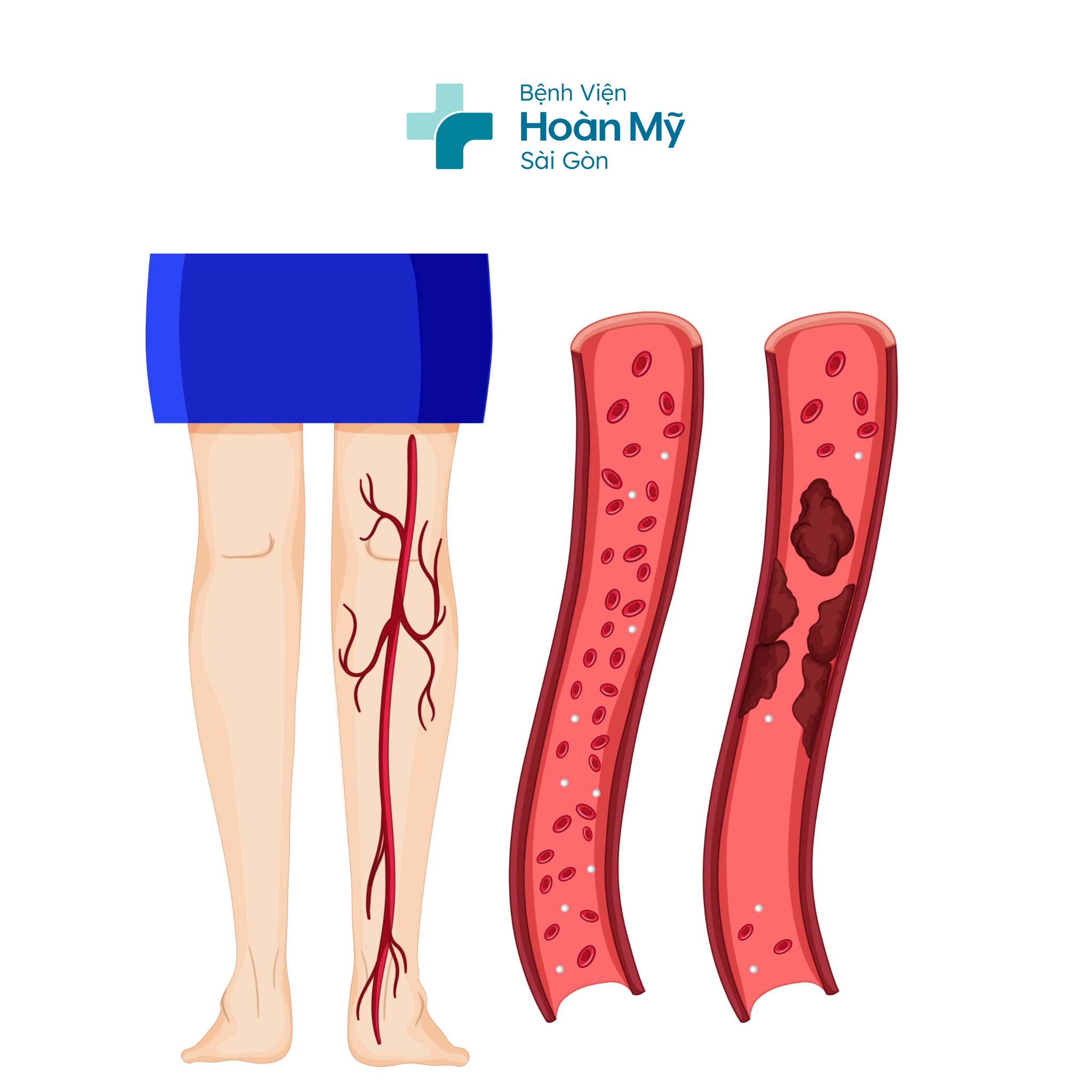 Tắc động mạch chi cấp – Tình trạng cấp cứu khẩn cấp cần can thiệp kịp thời