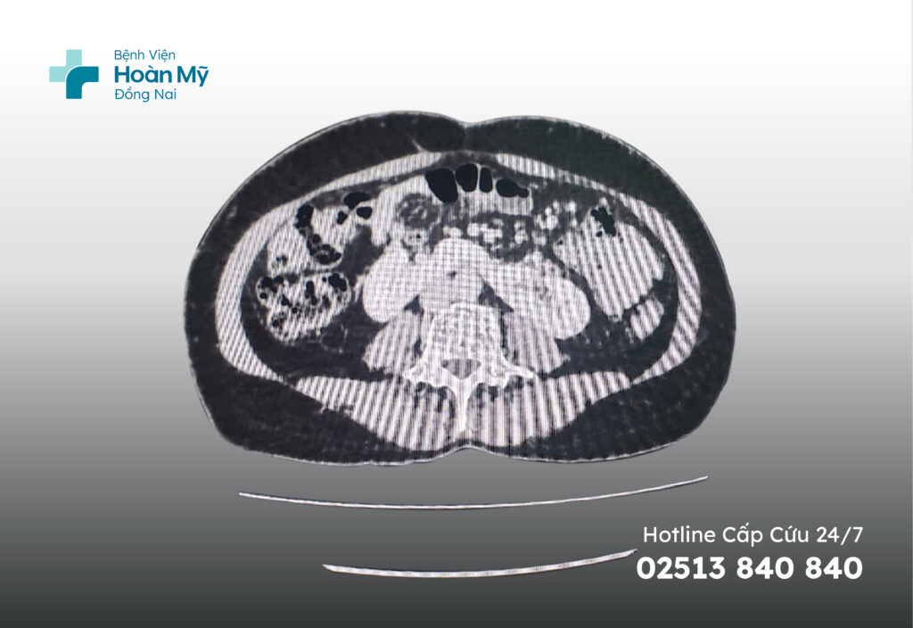 Nhập viện vì đau lưng, tình cờ phát hiện dị tật thận móng ngựa