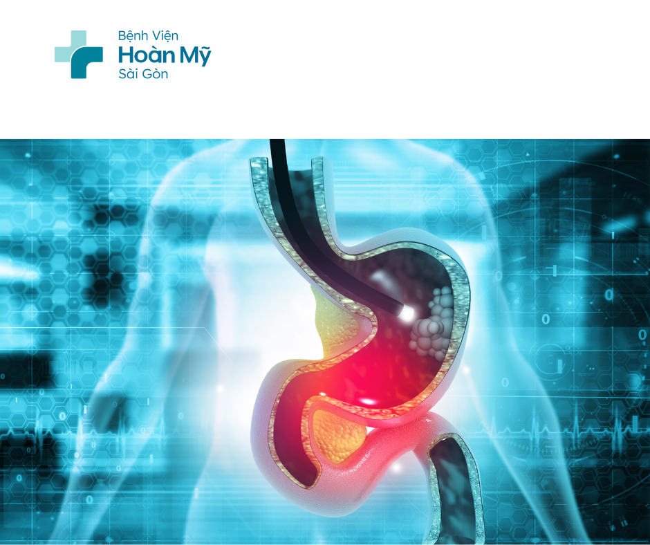 Nội soi tầm soát giúp phát hiện và điều trị thành công ung thư tiêu hóa giai đoạn sớm