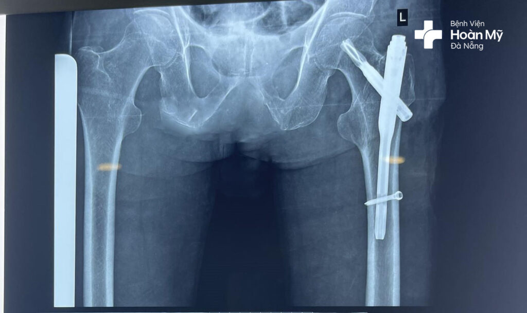 Hình ảnh kết hợp xương bằng đóng đinh nội tủy sau phẫu thuật cho người bệnh
