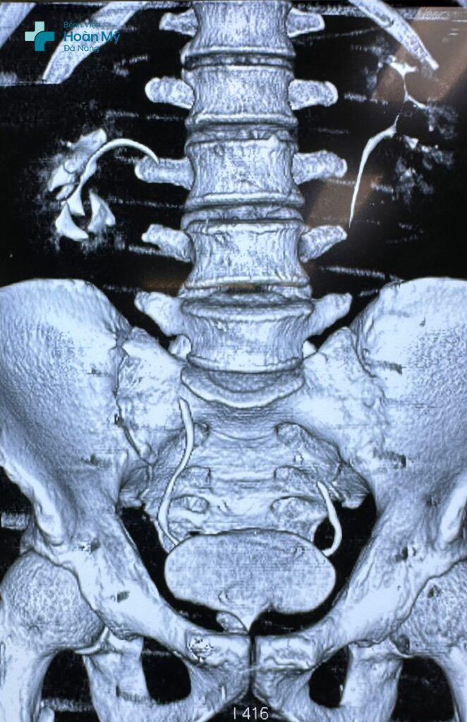 Nang thận chèn ép mô thận và đẩy niệu quản lên trên