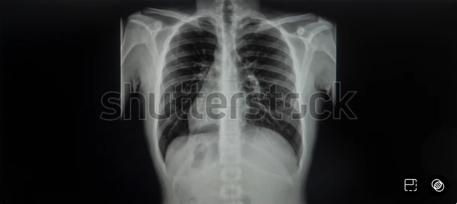 Những lưu ý cho người có trái tim nằm bên phải