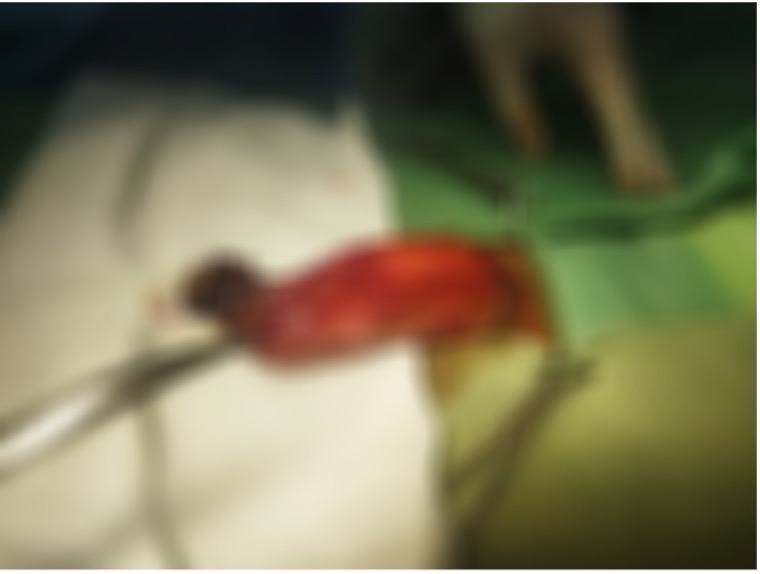 CẤP CỨU NGƯỜI BỆNH BỊ MẤT HOÀN TOÀN DA DƯƠNG VẬT DO MÁY QUẤN