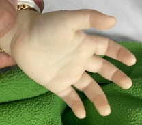 CẢNH BÁO THIẾU MÁU, THIẾU SẮT Ở TRẺ EM