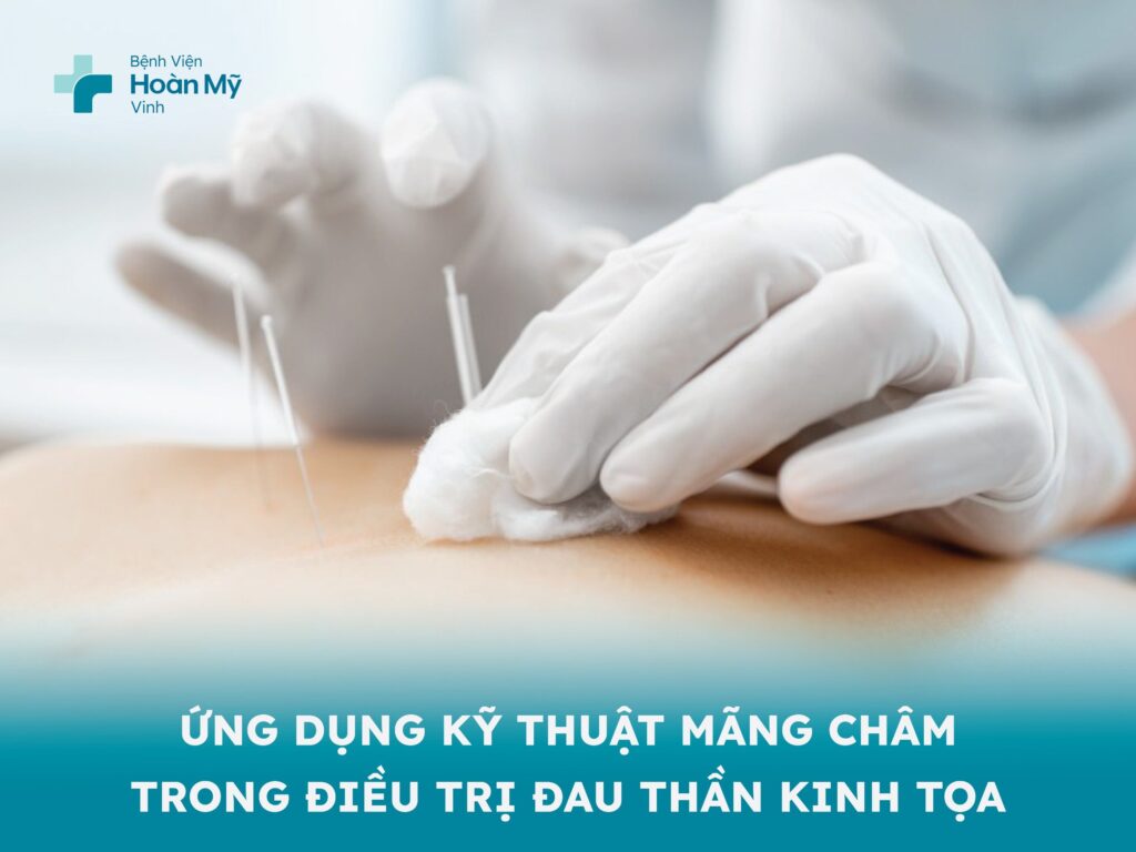 Ứng dụng kỹ thuật mãng châm trong điều trị đau thần kinh tọa
