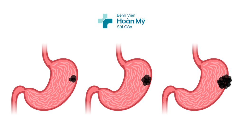 Khám, chẩn đoán và điều trị đa mô thức trong ung thư dạ dày