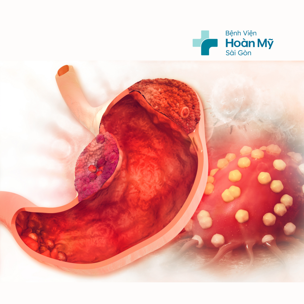 Xuất huyết đường ruột: nguyên nhân và cách điều trị