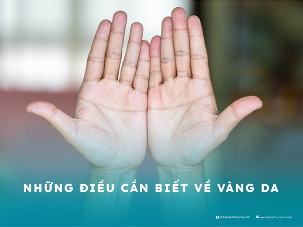 Những điều cần biết về vàng da