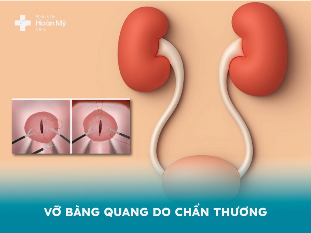 Vỡ bàng quang do chấn thương