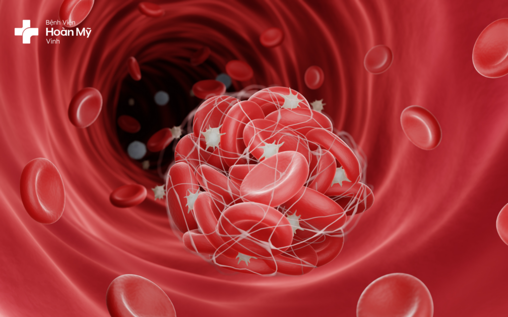 Những điều bạn cần biết về hội chứng rối loạn đông máu