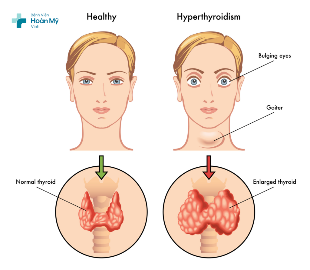Bệnh Basedow ở thanh thiếu niên