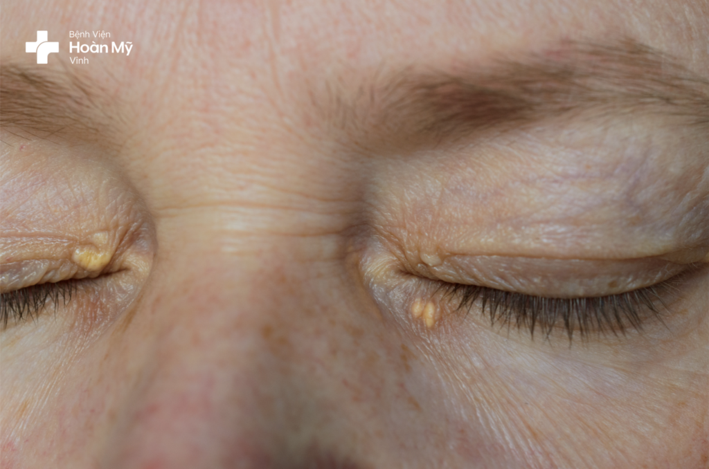 U vàng Xanthoma: Tất tần tật từ A đến Z