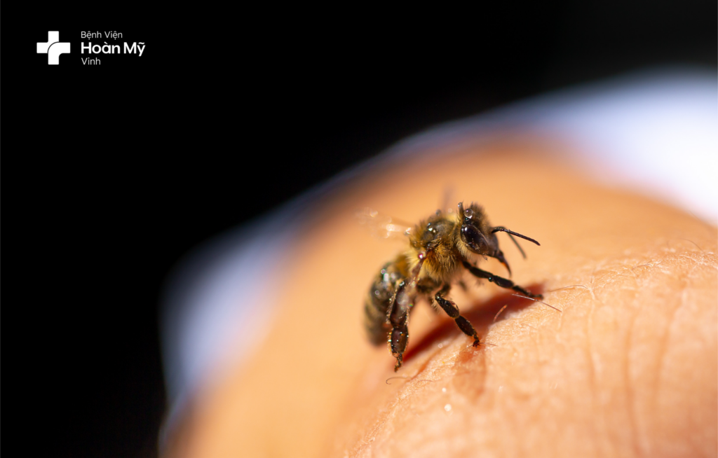 Triệu chứng và cách xử trí khi bị ong đốt