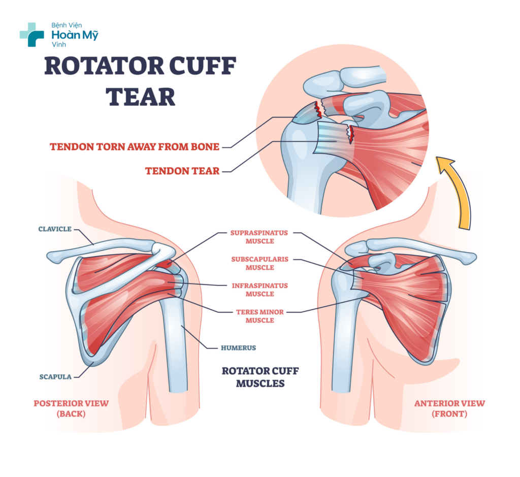 Chẩn đoán rách chóp xoay khớp vai