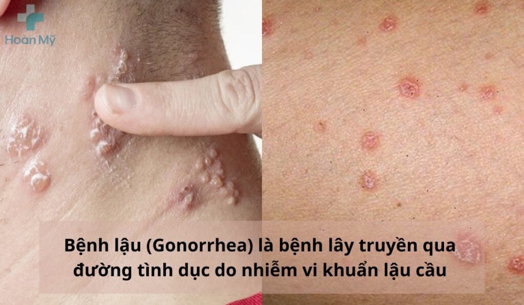 Bệnh lậu là gì? Nguyên nhân, dấu hiệu & cách điều trị bệnh