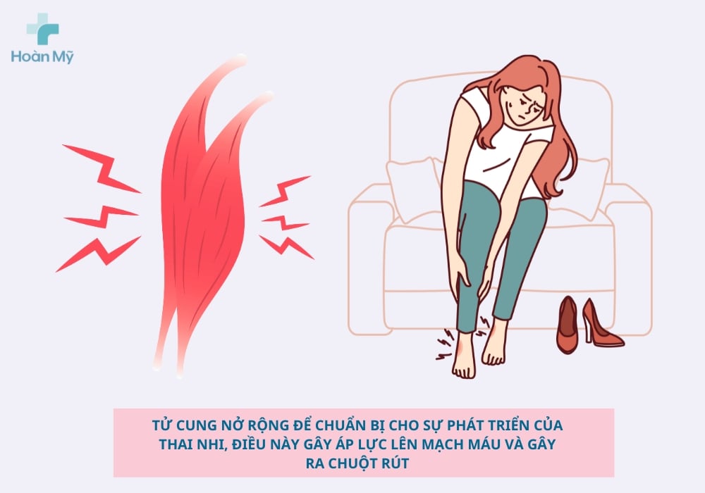 Chuột rút là dấu hiệu mang thai dễ nhận biết