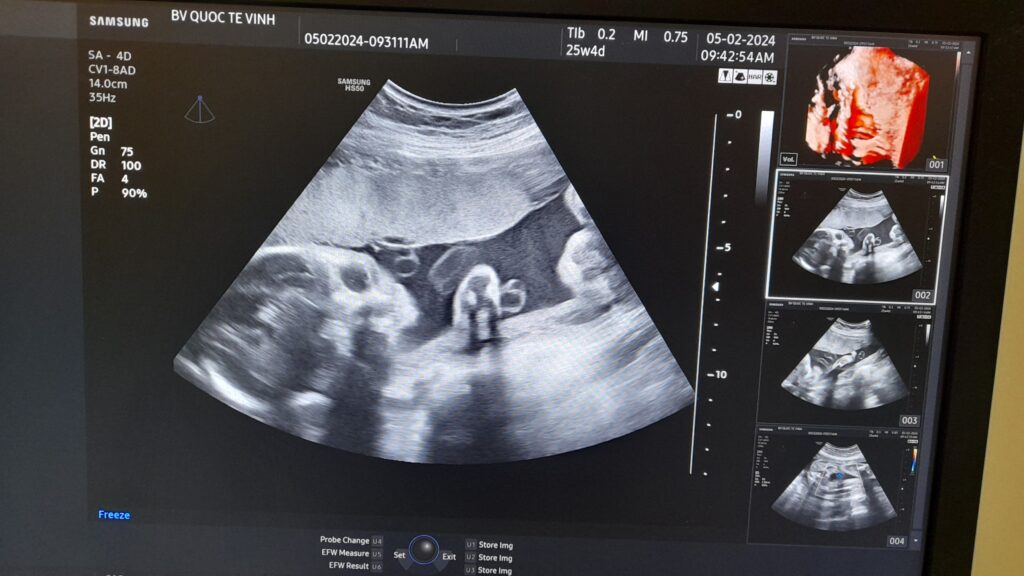 siêu âm phát hiện dây rốn một động mạch